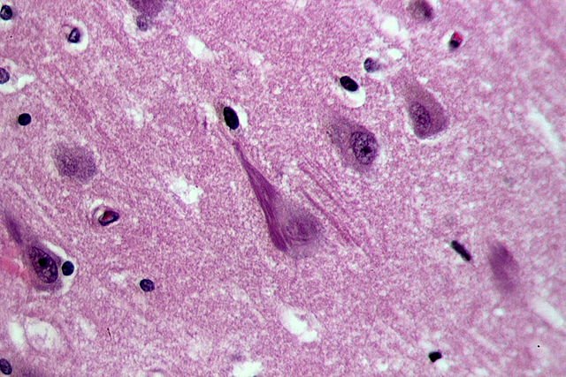 Alzheimer-Fibrillen unter dem Mikroskop - Wikipedia